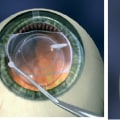 Understanding Implantable Contact Lenses (ICLs)