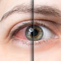 Understanding Glaucoma Prevention and Management