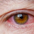 Dry Eye Syndrome: What You Need to Know for Healthy Eyes