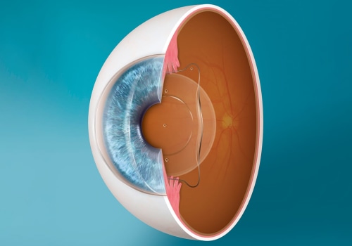 Before and After Photos of ICL Results: A Look at the Success of ICL Procedures