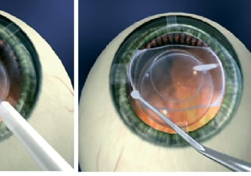 Understanding Implantable Contact Lenses (ICLs)