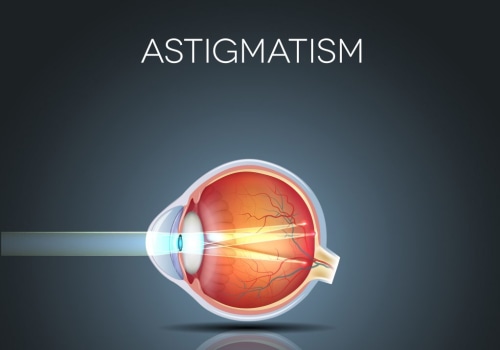 Causes and Symptoms of Astigmatism