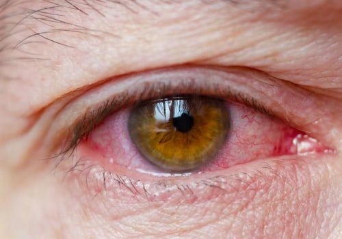 Dry Eye Syndrome: What You Need to Know for Healthy Eyes